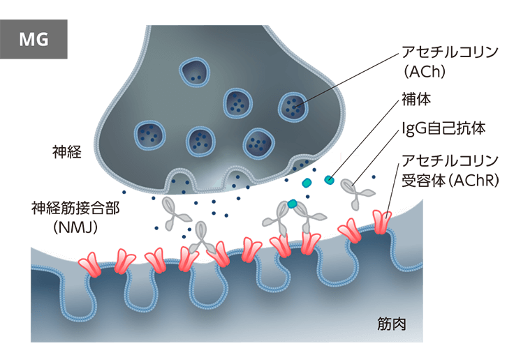 MGでは、IgG自己抗体が神経筋接合部のはたらきを阻害