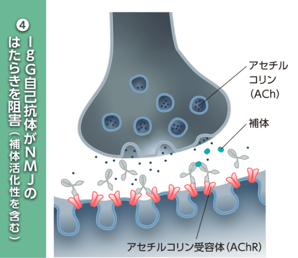 ④IgG自己抗体がNMJのはたらきを阻害（補体活化性を含む）