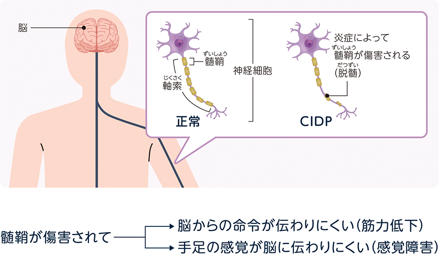 CIDPとは