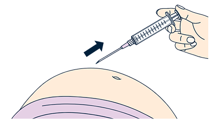 薬液を全量注入したことを確認した後に、皮膚をつまんでいた手をはなし、注射針を刺した角度と同じ角度で抜きます。