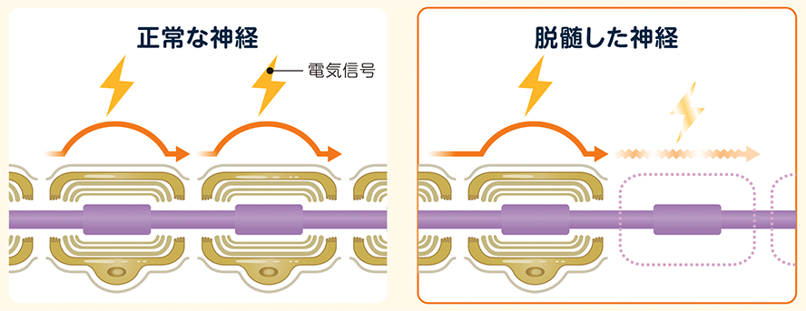 浸透圧性脱髄症候群とは？MRI画像診断のポイント！(橋中心髄鞘